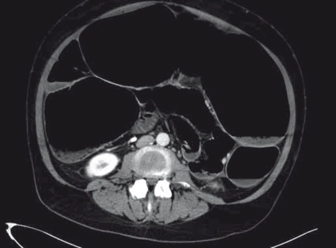 CT břicha při přijetí.
Fig. 2. Abdominal CT scan on admission.