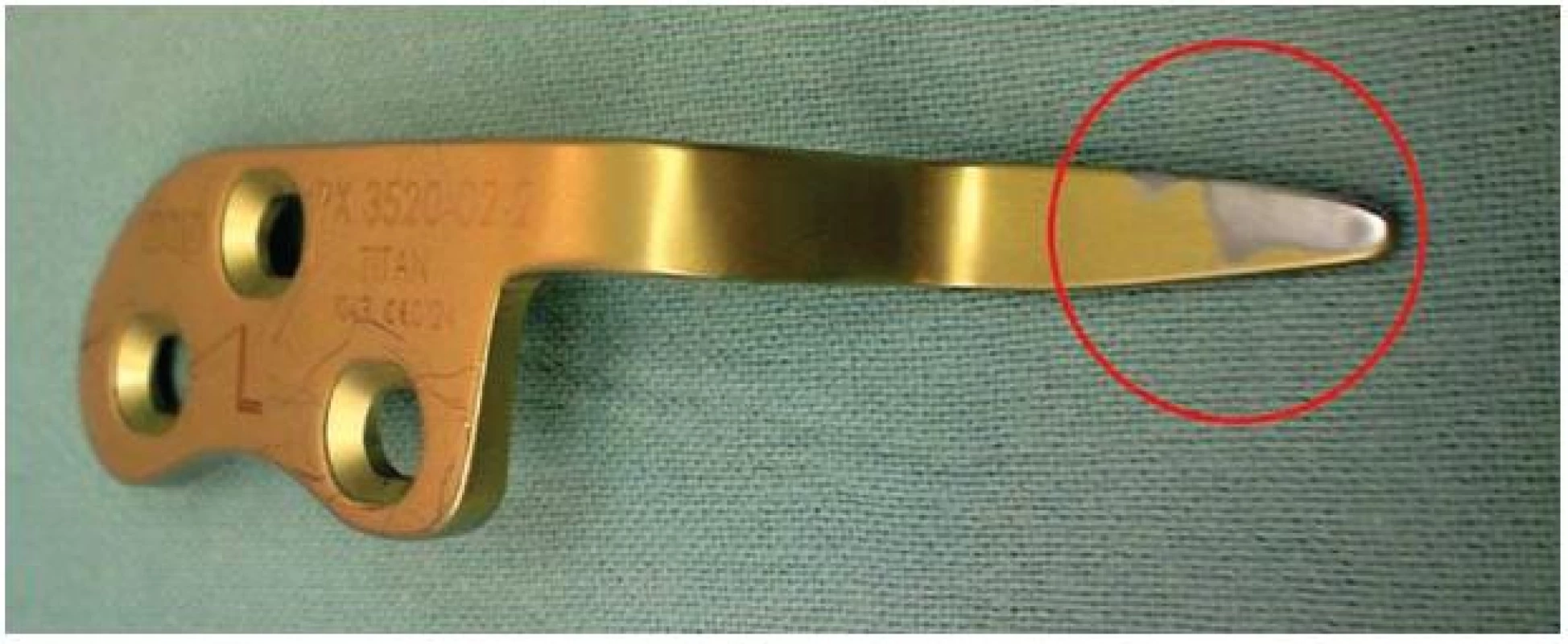 Dlaha po extrakci, je patrný otěr materiálu v místě kontaktu s akromiem
Fig. 4: Implant removal. Abrasion can be seen in the place of contact with the acromion