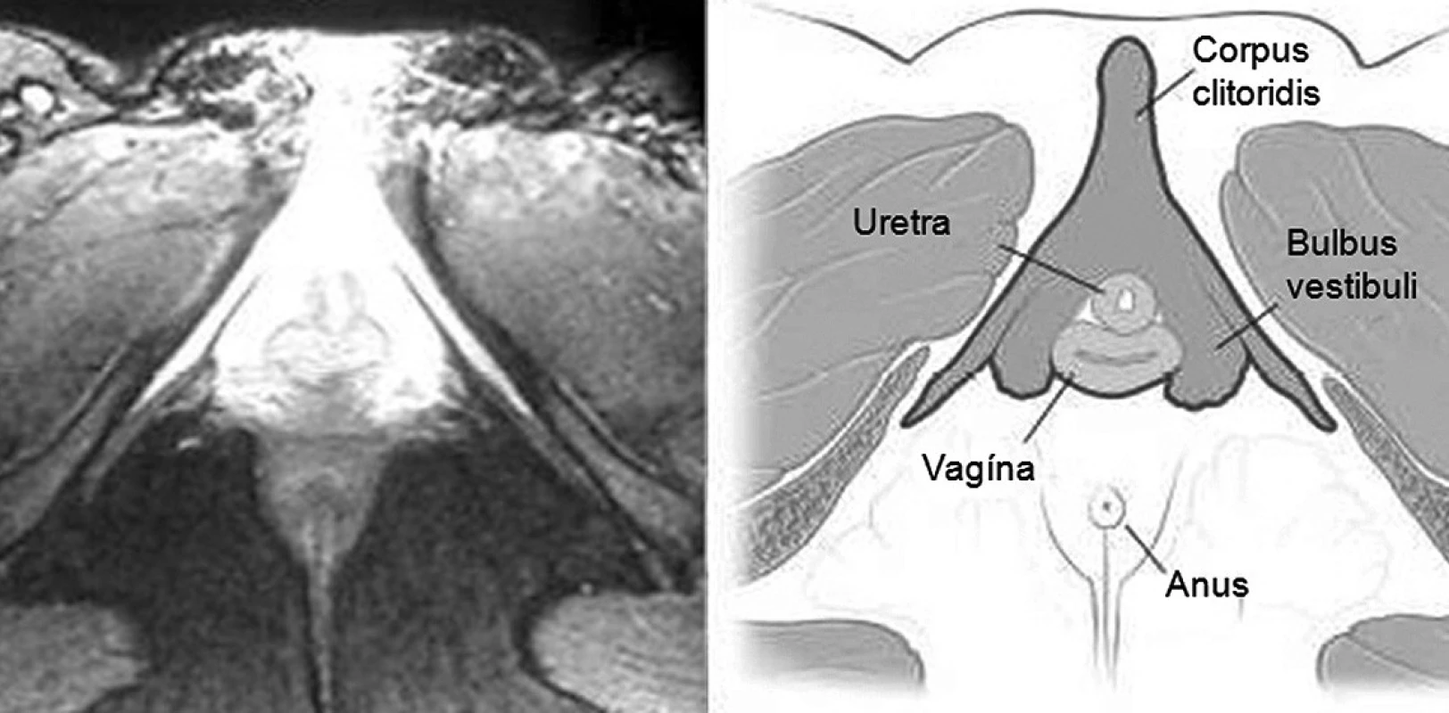 Zobrazení trojúhelníkovitého clitoro-uretro-vaginálního komplexu demonstrující intimní vztah kavernózních tkání k přední stěně distální vaginy (zdroj: O’Connell, HE., DeLancey J. Clitoral
anatomy in nulliparous, healthy, premenopausal volunteers using unenhanced magnetic resonance imaging. J Urol, 2005, 173, p.2060–2063)