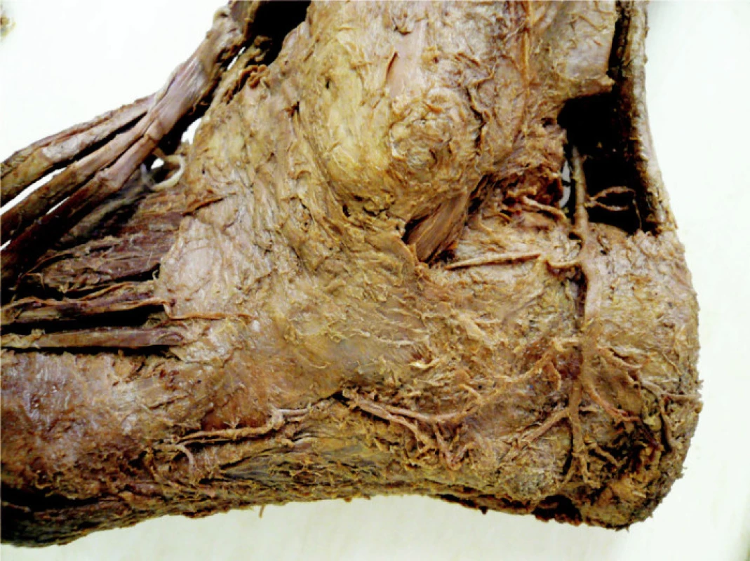 Preparát II – rozeznatelný anastomozující oblouk
Fig. 3. Preparation II – a detectable anastomotic arch
AŠ – Achillova šlacha, LCA – laterální kalkaneární arterie, LTA – laterální tarsální arterie, LMA – laterální malleolární arterie
AŠ – Achilles tendon, LCA – lateral calcaneal artery, LTA – lateral tarsal artery, LMA – lateral malleolar artery