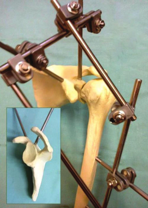 Způsob aplikace zevního fixatéru ramene na modelu.
Fig. 1: Application of the external fixation device in a model