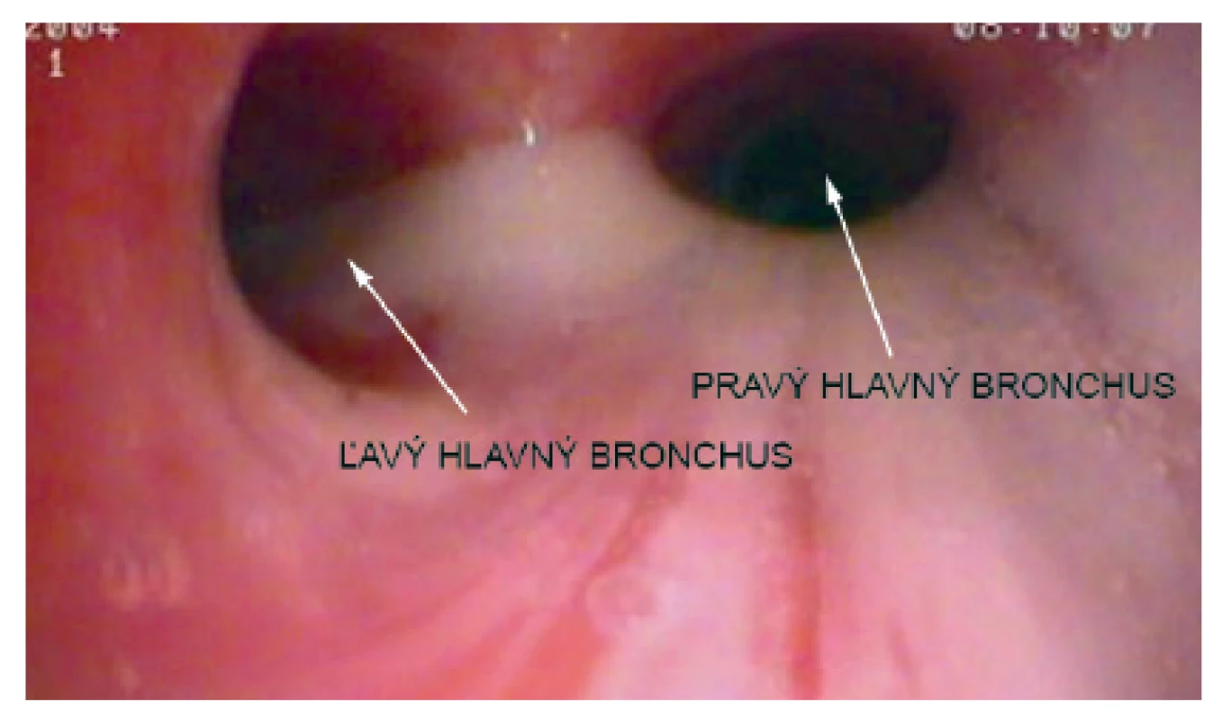 Bronchoskopický nález u našej pacientky – hustý belavý hlien vytekajúci z trachey.
Fig. 2. Bronchoscopic findings in our patient – thick white mucus flowing out of the trachea.