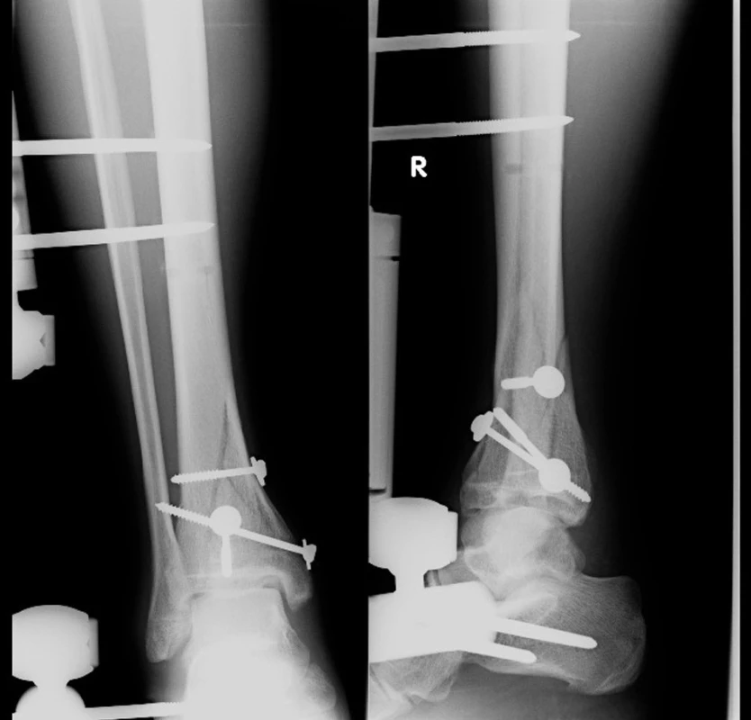 Miniosteosyntéza a zevní fixátor
Fig. 3: Miniosteosynthesis and external fixator