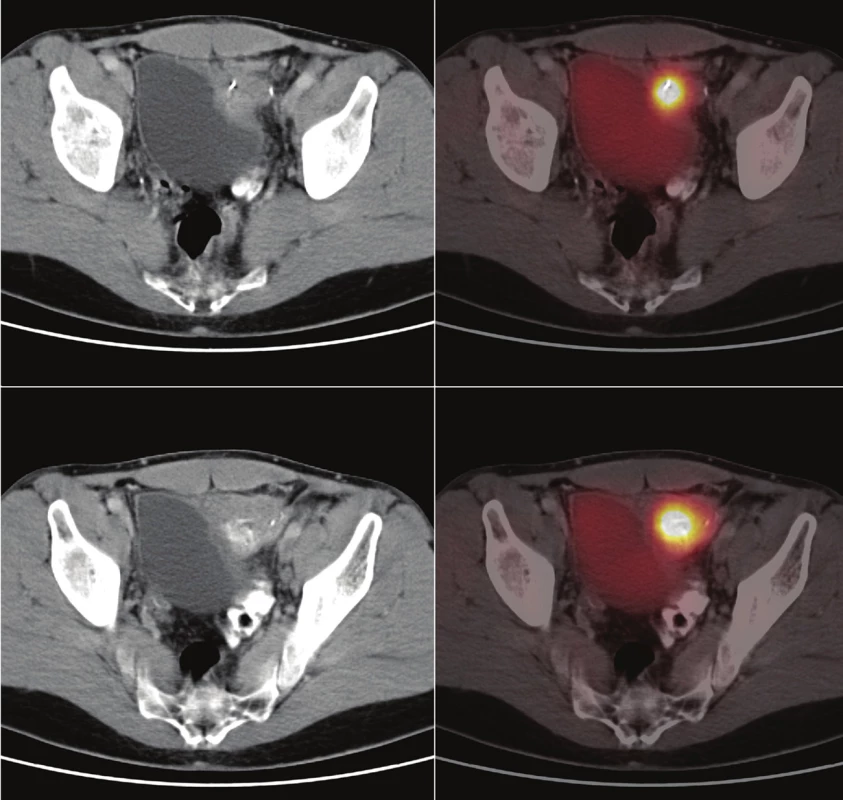 Dva transverzální řezy pánví získané metodou PET/CT (vlevo CT složka, vpravo fuzní zobrazení PET a CT). Vlevo před močovým měchýřem je patrný infiltrát zaujímající do sebe střevo, stěnu močového měchýře a kovové svorky. V PET obraze je v infiltrátu patrný výrazně zvýšený metabolismus glukózy, který odpovídá vysoké zánětlivé aktivitě