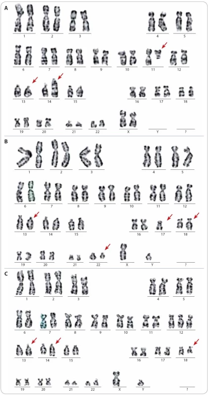 Translokace nalezené při cytogenetickém vyšetření.
Obr. 2 A. 46,XX,del(13q14),t(11;14)(q13;q32), Obr. 2 B. 45,XY,-17,t(18;22)(q21;q11), Obr. 2 C. 47,XY,+12,del(13q14),t(14;18)(q32;q21).
