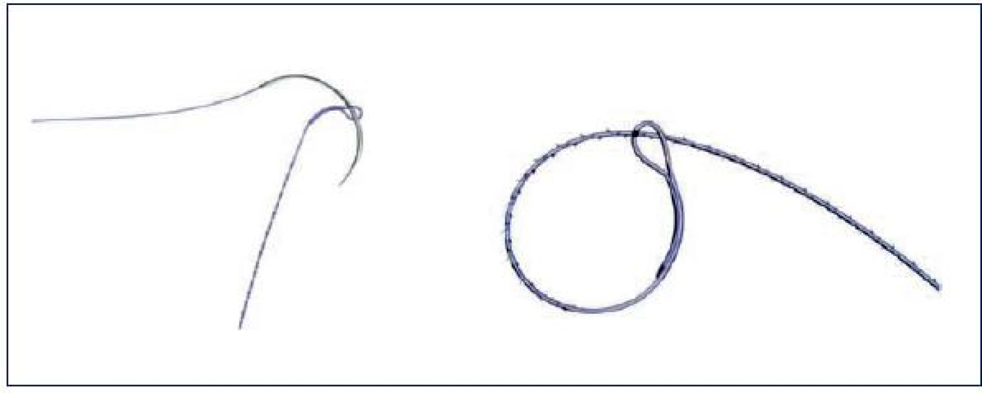 Protažení jehly koncovým okem
Převzato: Greenberg JA. The use of barbed sutures in obstetrics and gynecology. Rev Obstet Gynecol 2010; 3(3): 82–91.
Fig. 2. The stretching a needle the eye at the end of a stitch
Source: Greenberg JA. The use of barbed sutures in obstetrics and gynecology. Rev Obstet Gynecol 2010; 3(3): 82–91.