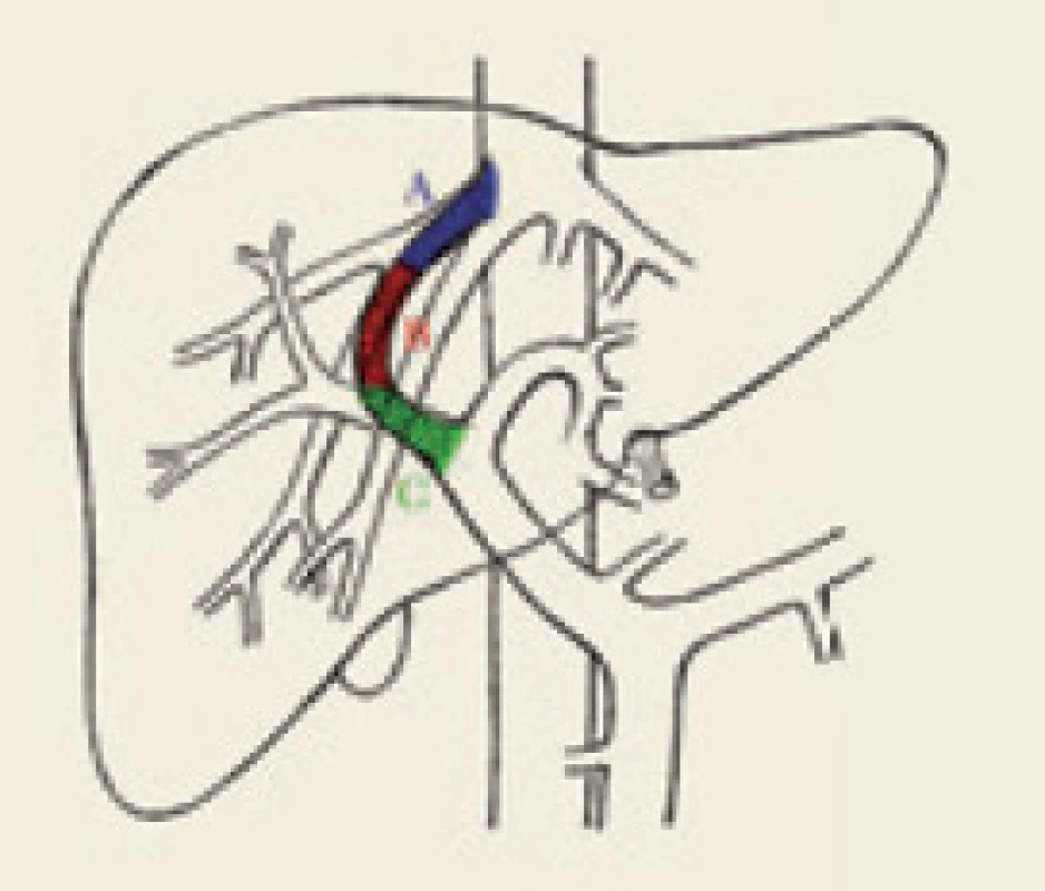 Schéma lokalizace výskytu stenóz TIPS: A (modrá) – výtokové stenózy, B (červená) – intraparenchymové stenózy, C (zelená) – vtokové stenózy.
Fig. 1. Schematic localization of TIPS stenosis: A (blue) – outflow stenosis, B (red) – intraparenchymal stenosis, C (green) – infl ow stenosis.