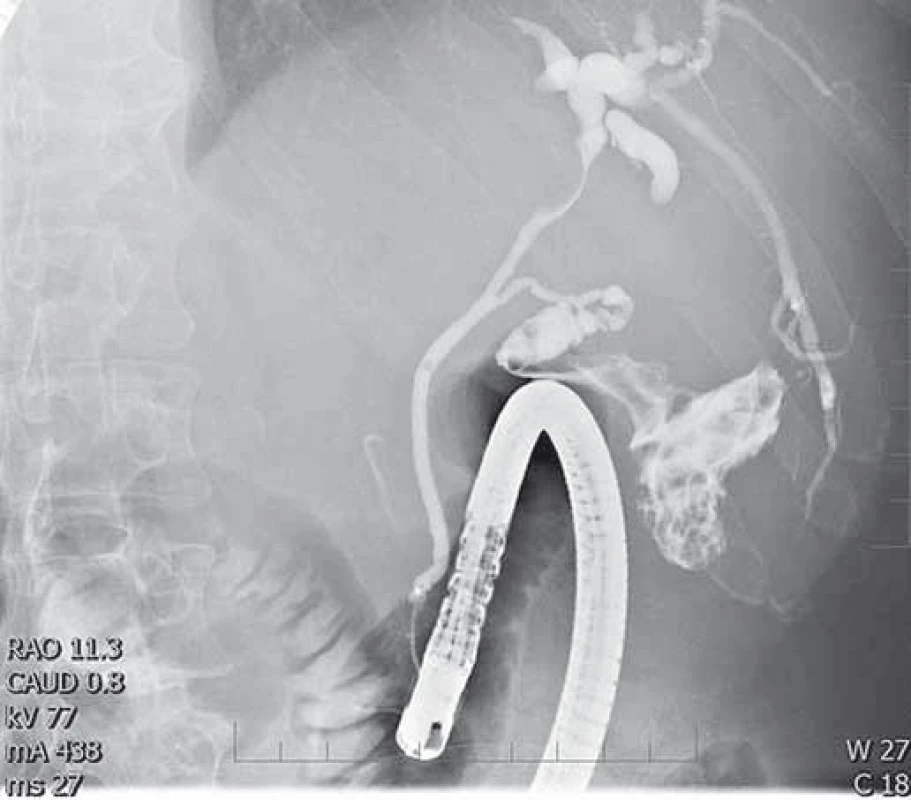 Útlak ductus hepaticus communis uzlinovým procesem v jaterním hilu. ERCP, cholangiogram.
Fig. 5. Common bile duct stenosis caused by lymph nodes in the liver hilum. ERCP, cholangiogram.