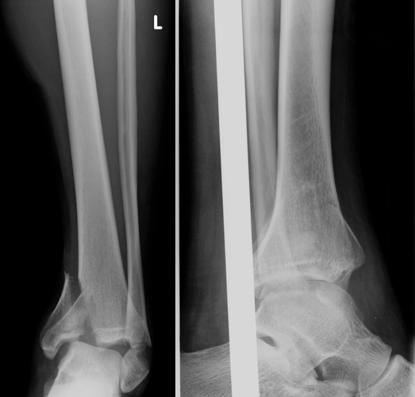 Vstupní rtg recentně po úrazu
Fig. 10: Initial X-ray shortly after injury