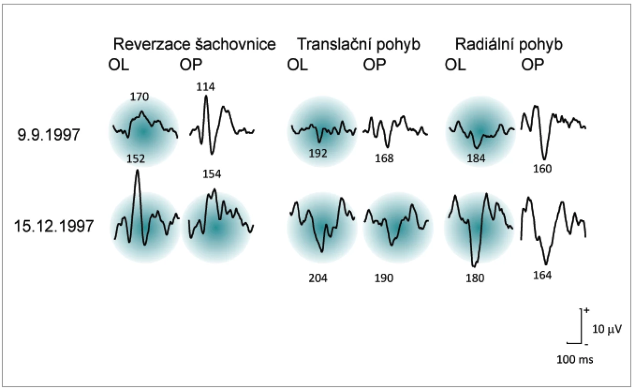 Ukázka nálezů VEPs u pacientky s opakovanou ON u níž byla diagnostikována RS. Latence převyšující limit = průměr +2,5 SD jsou označeny zeleným pozadím.