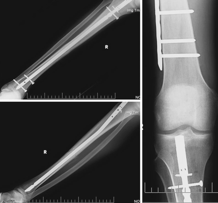 Zlomenina tibie vpravo, nitrodřeňová osteosyntéza
