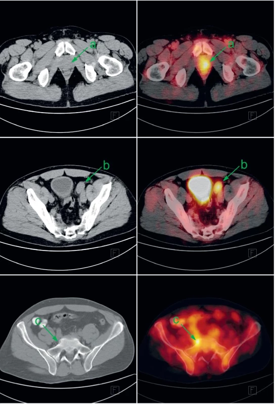 Pacient s biopticky ověřeným anaplastickým karcinomem prostaty byl v rámci iniciálního stagingu indikován k FDG-PET/CT. Patologicky zvýšená konsumpce glukózy v prostatě (a), zvětšené parailické uzlině vlevo (b) a v drobné kostní lézi sakra vpravo (c) svědčí pro generalizaci karcinomu prostaty. V močovém měchýři a ve střevech je akumulace FDG fyziologicky zvýšená. Vlevo CT v režimu nízké dávky, vpravo jeho fúze s FDG-PET.
Fig. 1. Patient with bioptically proven anaplastic prostate cancer was investigated by FDG-PET/CT as a part of initial staging. Abnormally increased glucose consumption in prostate (a), in enlarged left parailiac lymph node (b) and discrete bone lesion of the sacrum (c) represents metastatic prostate cancer. Increased FDG uptake in urinary bladder and gut is a normal variant. Left: low-dose CT; right: fusion of low-dose CT with FDG-PET.