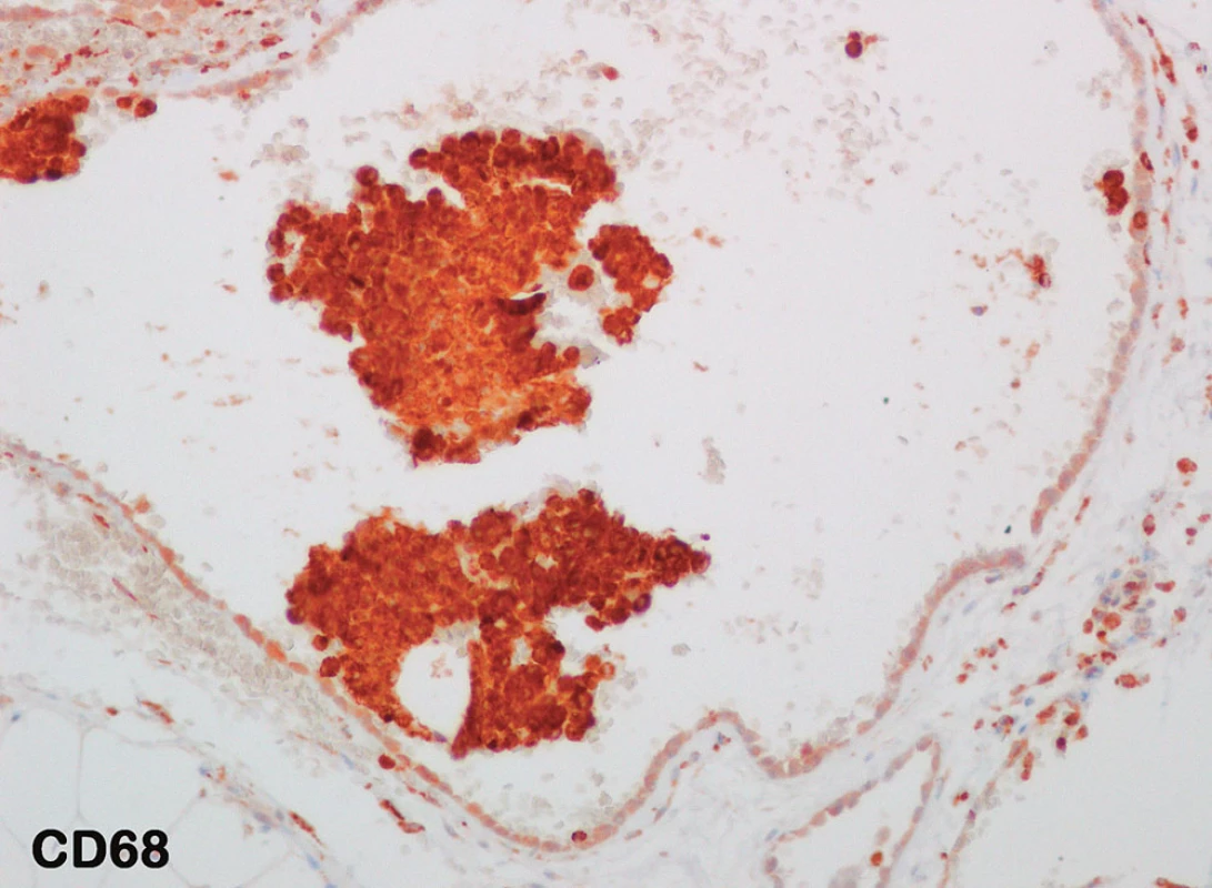 Imunohistochemické vyšetření s protilátkou proti CD 68 antigenu: negativita ve výstelce cyst, pozitivní průkaz v solidních buněčných fragmentech