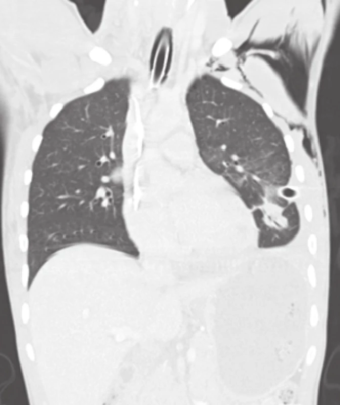 Obr. 1: Průstřel levé plíce, hrudní drén v levém hemitoraxu, podkožní emfyzém − koronální řez
Fig. 1: The bullet channel in the left lung, chest drain in the left hemithorax, subcutaneous emphysema − coronal section