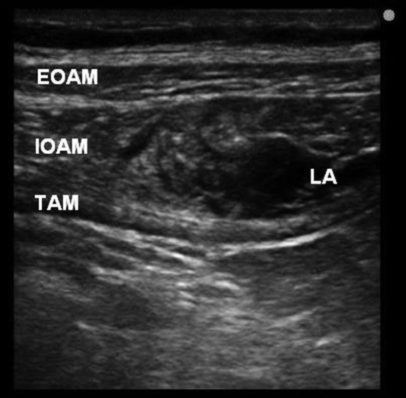 Distribution of local anaesthetic solution in transversus abdominis
plane between the internal oblique abdominis and transversus
abdominis muscles