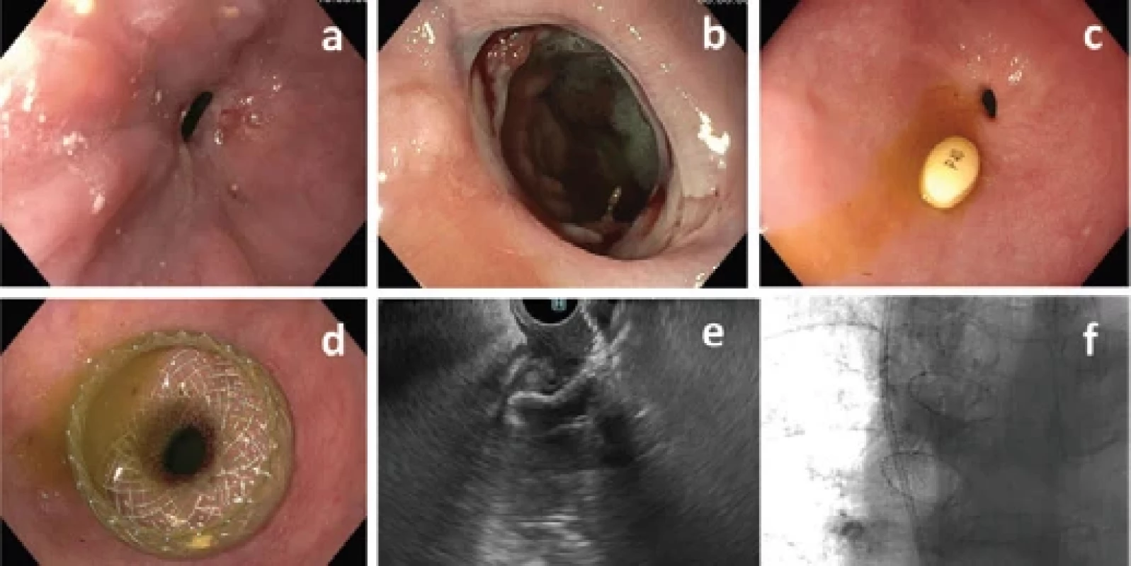 Endoskopický a radiologický management refrakterní stenózy gastroezofageální anastomózy (GEA).