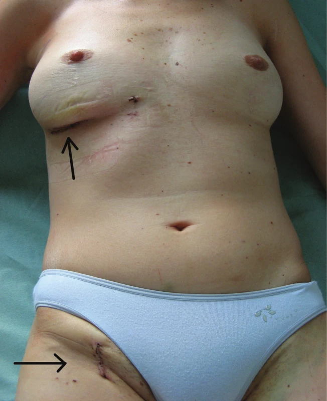 Výsledný kosmetický efekt
Minitorakotomie a rána v třísle.
Fig. 3: Postoperative aesthetic appearance 
Minithoracotomy and the wound in the groin.