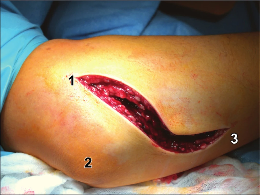 Rozšířený modifikovaný Kocherův přístup – kožní řez: 1 – epicondylus lateralis humeri, 
2 – olekranon, 3 – ulna.
Fig. 13: Extended modified Kocher approach – skin incision: 1 – lateral epicondyle of humerus, 
2 – olecranon, 3 – ulna.