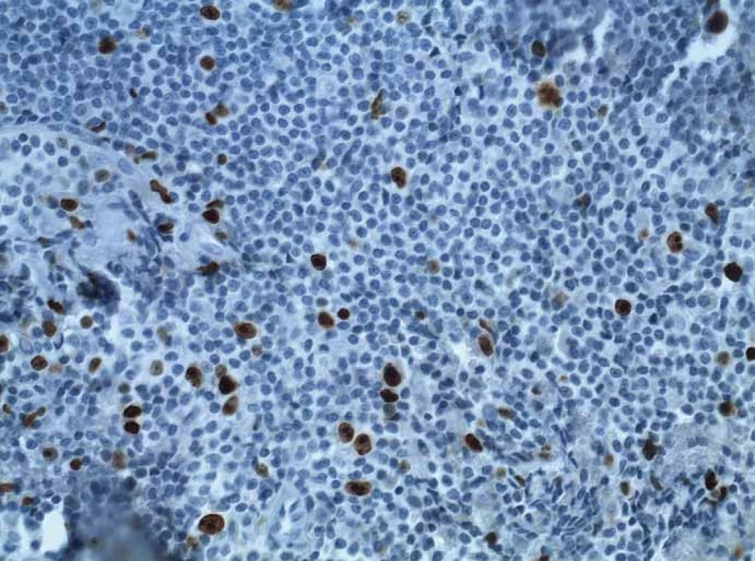 Imunohistochemie, proliferační marker Ki-67.
Fig. 5. Immunohistochemical staining, proliferation marker Ki-67.