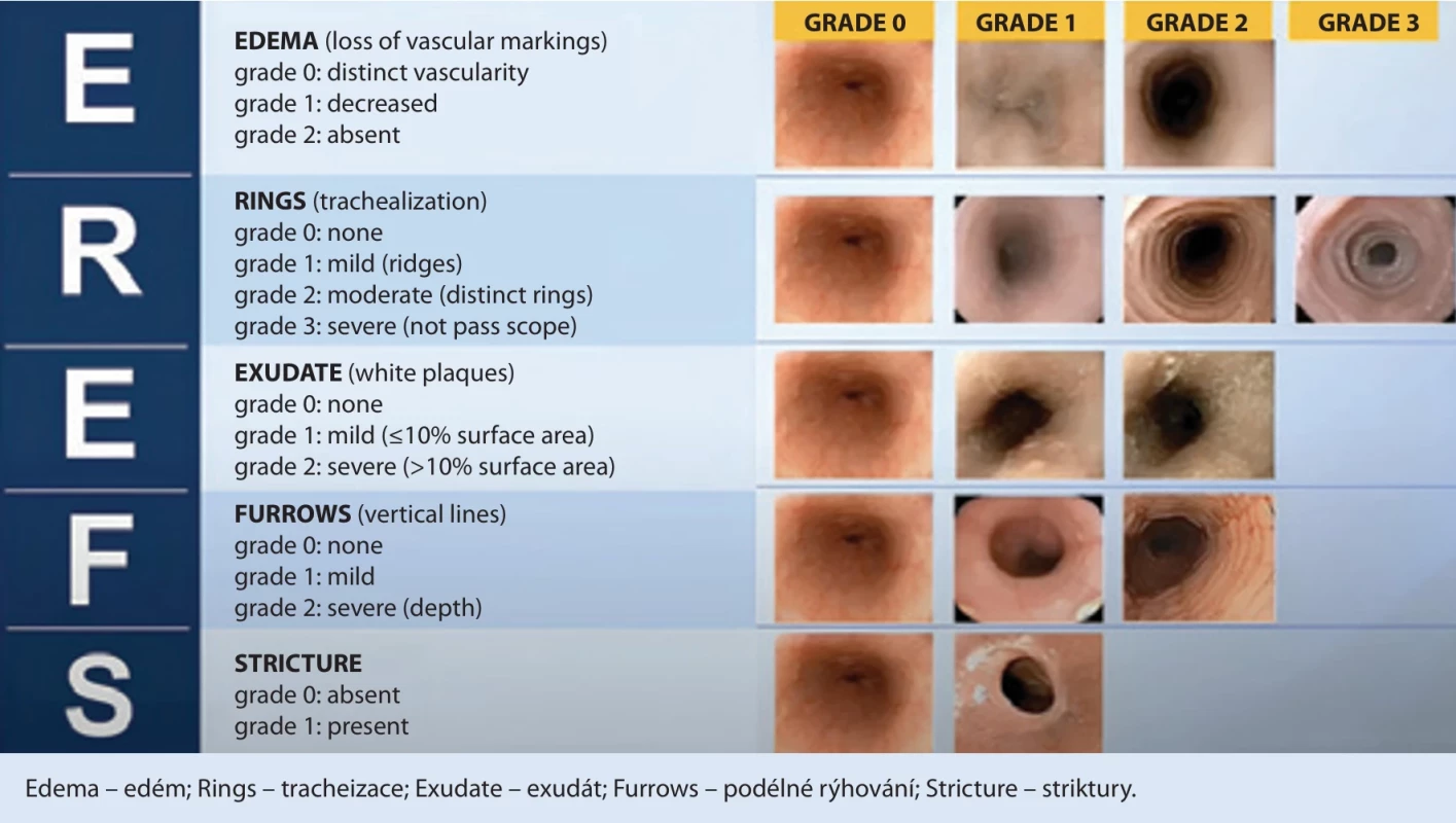 EOE endoskopické referenční skóre (EREFS) [ ]. Fig. 1. EOE endoscopic reference score (EREFS) [ ].