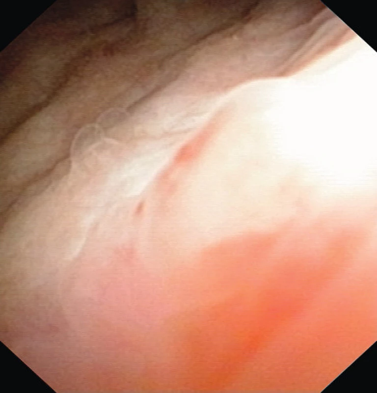 Cystoskopie čtyři měsíce po operaci
Fig. 6. Cystoscopy four months after TUR