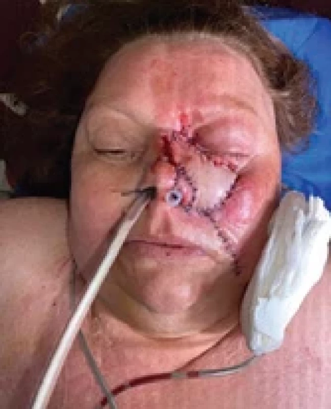 Peroperative photography of reconstruction with the double island radial forearm free fl ap (for infraorbital region and internal nasal lining) and free helical rim fl ap for the left nasal alai.