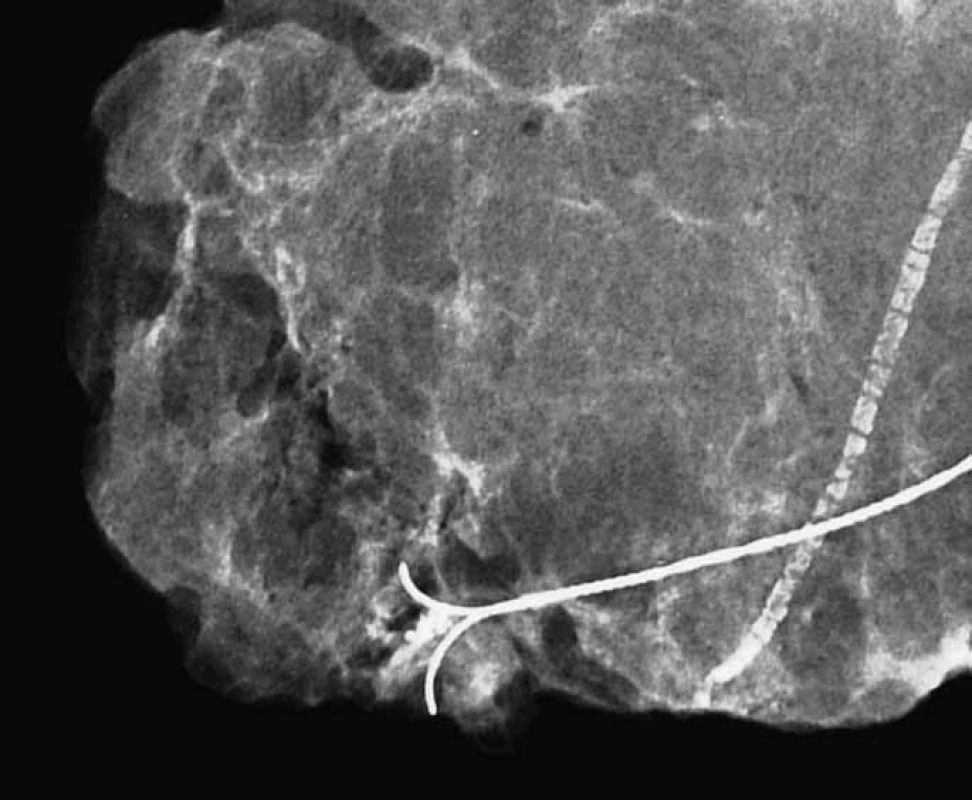 <em>Specimen radiography</em>, převážně tukový exstirpát, shluk mikrokalcifikací na rozloze 3,5 mm. Nápadná vazoskleróza. Histologicky prokázán kribriformní + komedo in situ karcinom, Grade 3, vysoce pozitivní hodnota obou steroidních receptorů.