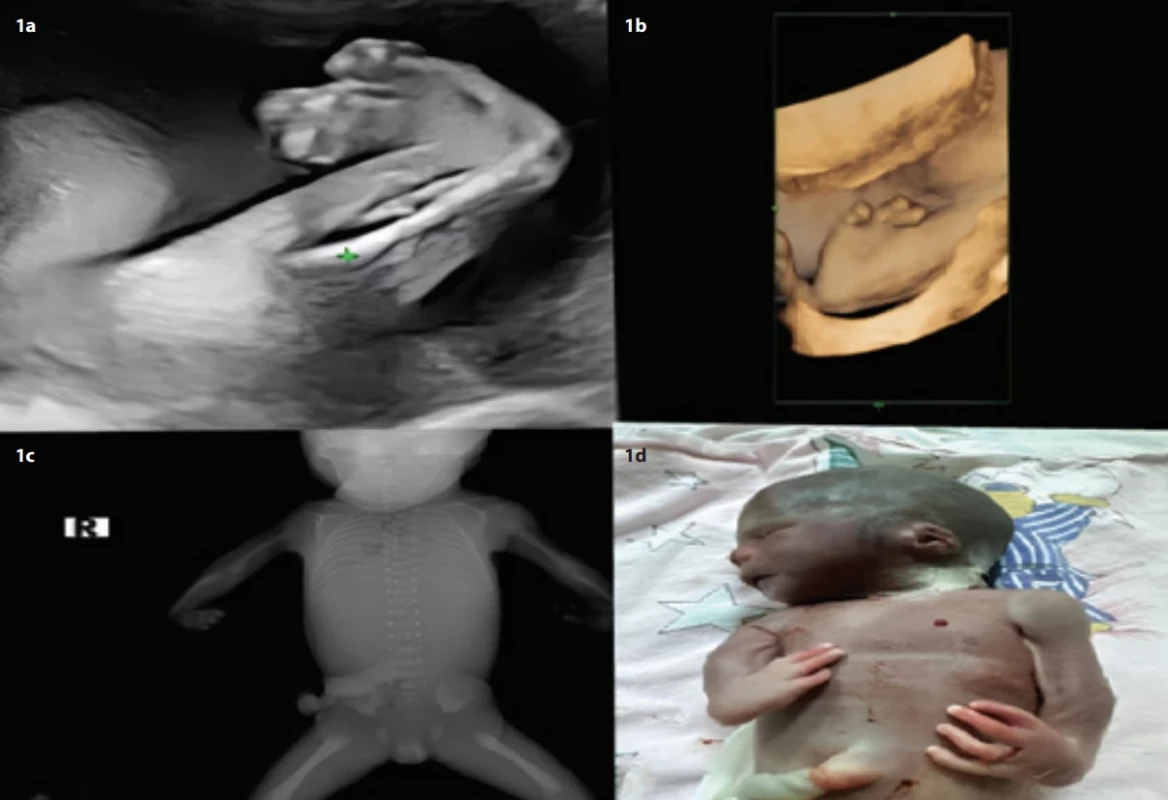 1a. Case 12 – grayscale right 2D radial ray deformity at 25th gestational week. 1b. Case 12 – 3D radial deviation-radius, lack of 1–2 metacarpals and phalanges. 1c. Case 1 – radial deviation postmortem x-ray. 1d. Case 12 – fetal necropsy fi ndings. Obr. 1a. Případ 12 – deformita pravého radiálního paprsku v odstínech šedi na 25. gestačním týdnu. 1b. Případ 12 – 3D deviace radiálního paprsku, chybějící 1–2 metakarpy a falangy. 1c. Případ 1 – deviace radiálního paprsku na rentgenovém snímku po smrti. 1d. Případ 12 – nálezy z pitvy plodu.