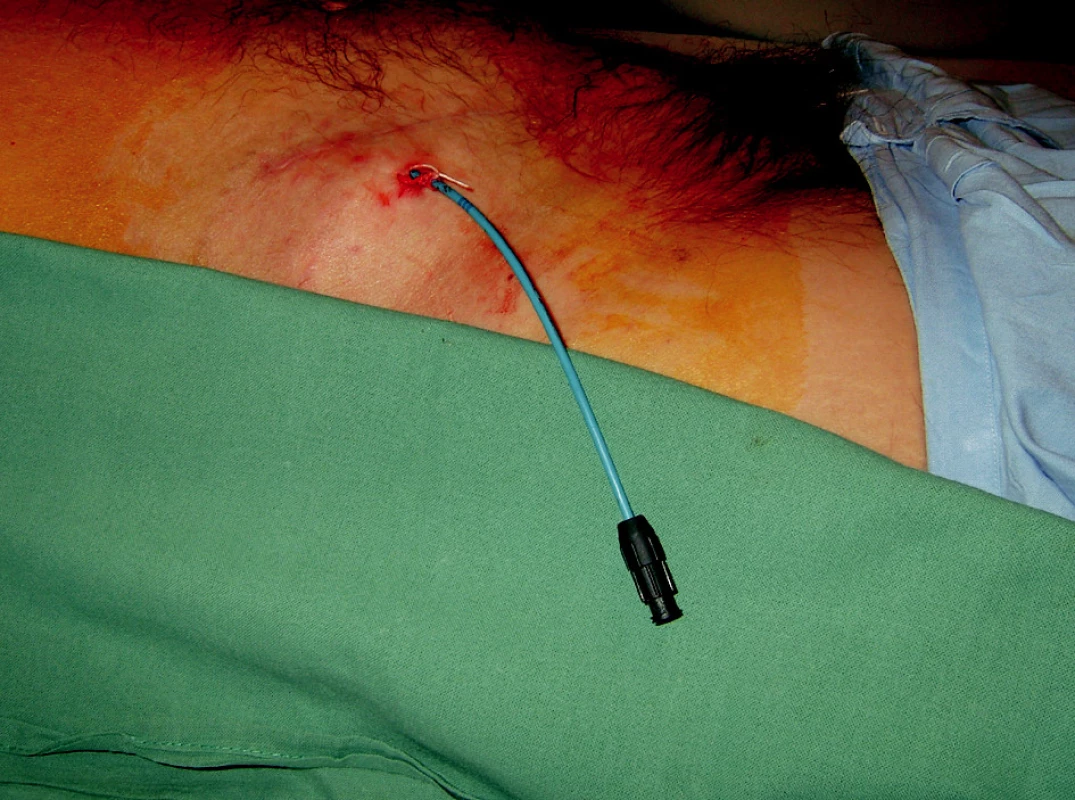 Perkutánní drén v lymfokéle v pravém podbřišku
Fig. 1. Percutaneous drain introduced in a lymphocele in the right hypogastrium