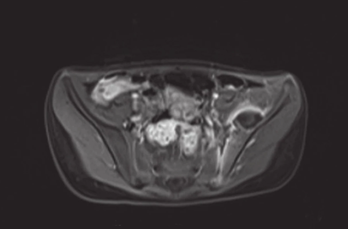 MRI pánve - absces mezi levou lopatou kosti kyčelní a musculus iliacus, sakroileitida vlevo
a) T2 TIRM transverzálně (sekvence s potlačením signálu tuku), tekutinové ložisko v pánvi vlevo, edém kosti, SI skloubení a musculus iliacus
b) DWI b800 transverzálně – hypersignální hladinka hnisu
c) ADC mapa transverzálně – v ložisku hyposignální hladinka hnisu
d) T2 sagitálně – ložisko s hladinkou, edém musculus iliacus
e) T1 VIBE transverzálně po kontrastní látce – prstenčité sycení stěny ložiska typické pro absces
f) T1 VIBE transverzálně po kontrastní látce – sycení okrajů ložiska a SI skloubení