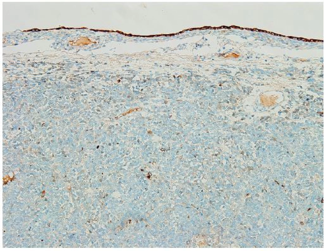 Imunohistochemické zpracování: Tumor reaguje ojediněle pozitivně pouze s OSCAR a častěji s p53. CK 7, CK 20, ER, PR, ALK1, inhibin alfa, SALL4, melanA, CD99, CD20, calretinin a EMA negativní.