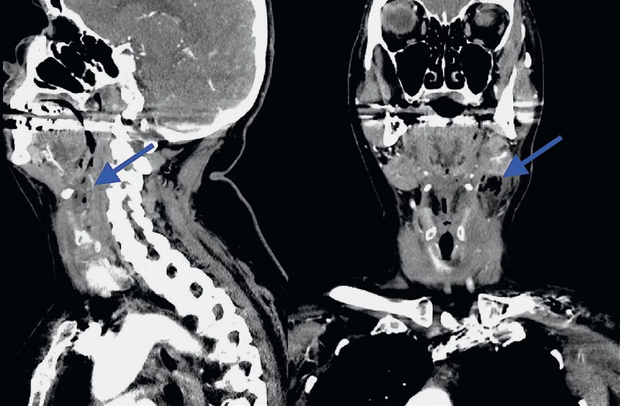 Parafaryngeální absces vlevo s bublinami plynu, CT s kontrastní látkou, sagitální a koronární řezy, absces označen šipkou.