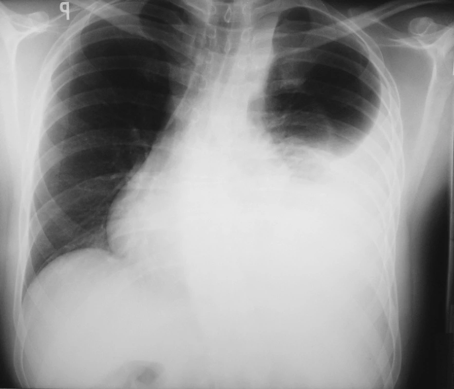RTG hrudníku při přijetí
Fig. 1. X-ray of chest on admission