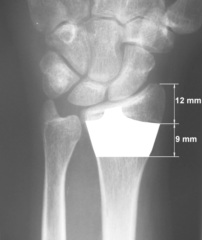 Indikační šíří hřebu jsou zlomeniny lokalizované ve zvýrazněné oblasti distálního rádia
Fig. 6. The nail indication areas include fractures located within the highlighted region of the distal radius