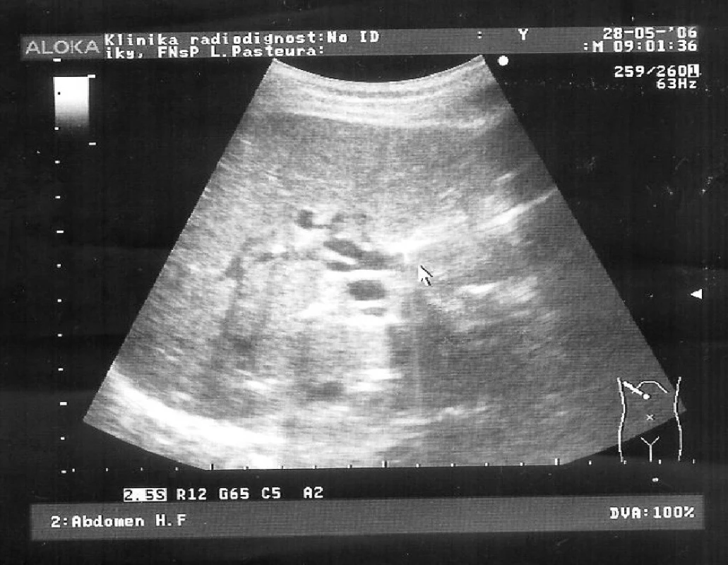 Ultrasonografia – aerobília (čierna šípka)
Pic. 5. Ultrasonography – aerobilia (black arrow)