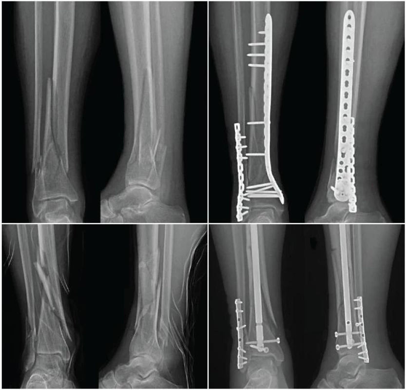 Podobné typy zlomenin s osteosyntézou dlahou a hřebem