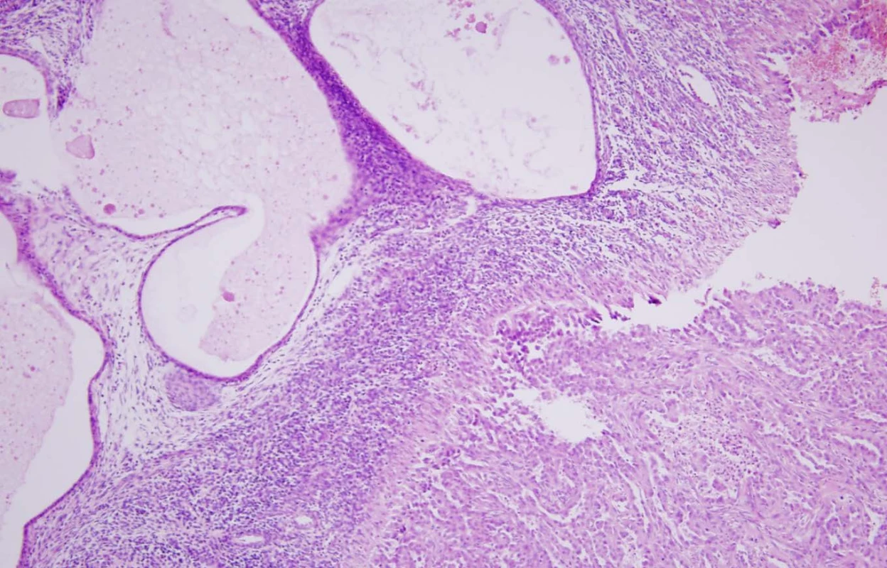 Histologické vyšetření preparátu tumoru ledviny: ložisko endometriózy s endometriálními žlázkami, zvětšení 100x
Fig. 4. Histological specimen of kidney tumor – focus of endometriosis with endometrial glands on the left part of the picture, ZOOM 100x