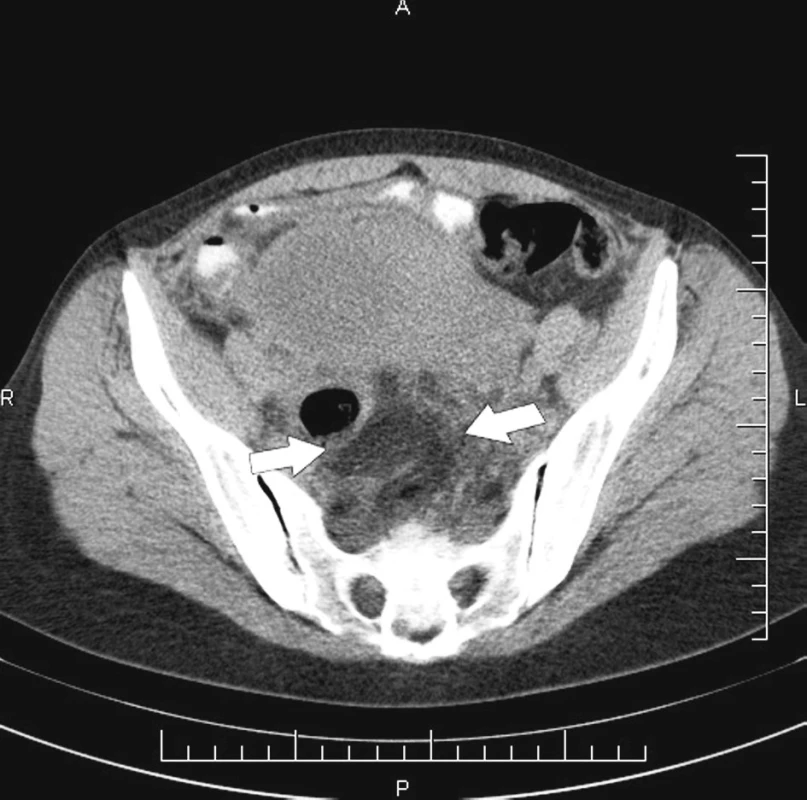 CT vyšetrenie pacientky po laparoskopickej apendektómii a spontánnom potrate. Absces v cavum Douglasi je označený bielymi šípkami
Pic. 1. CT imaging of the patient after laparoscopic appendectomy and spontaneous abortion. Abscess in cavum Douglasi is marked with white arrows
