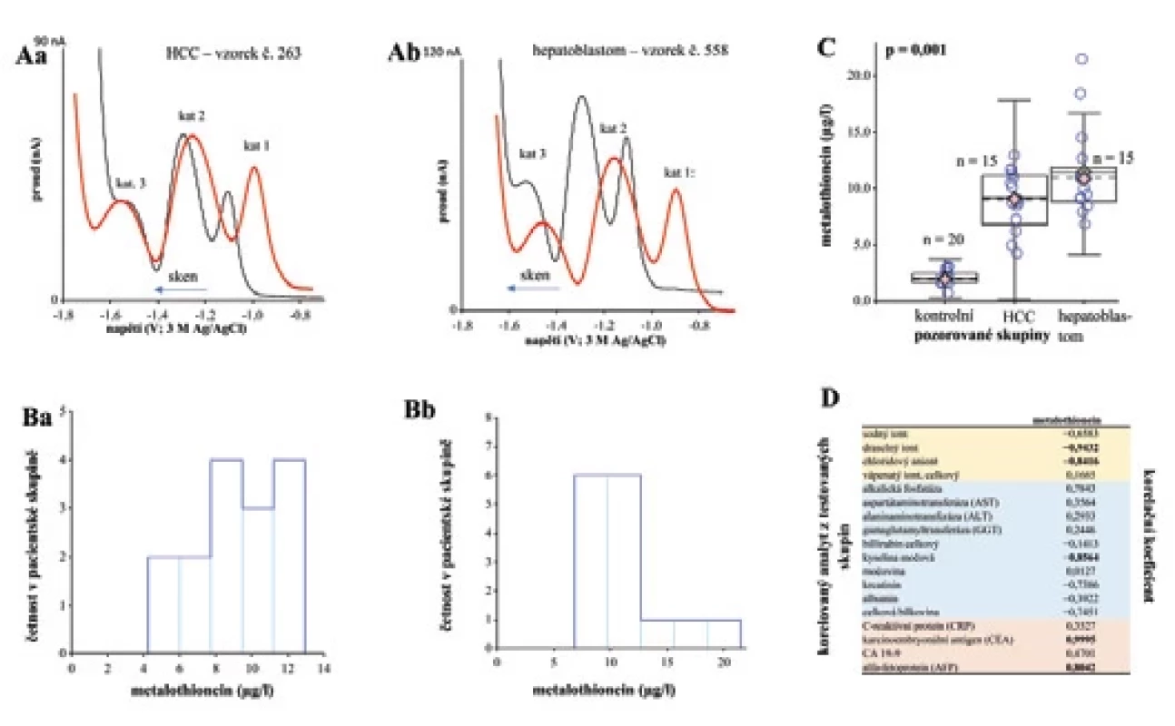 Elektrochemická analýza metalothioneinu (MT) u sledované skupiny pacientů s hepatocelulárním karcinomem (HCC) a hepatoblastomem.