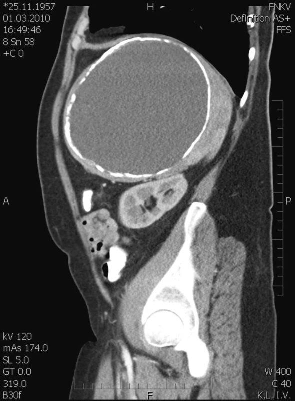 Poúrazová pseudocysta sleziny v CT scanu – sagitální řez
Fig. 3. Post-traumatic pseudocyst of the spleen on CT scan – saggital section