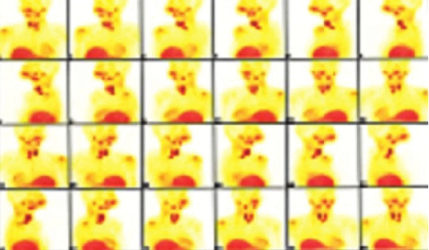 MIBI scintigrafie příštítných tělísek u pacientky s MEN 1 a HPT
Fig. 5: MIBI scintigraphy of the parathyroid glands in a patient with MEN 1 and HPT