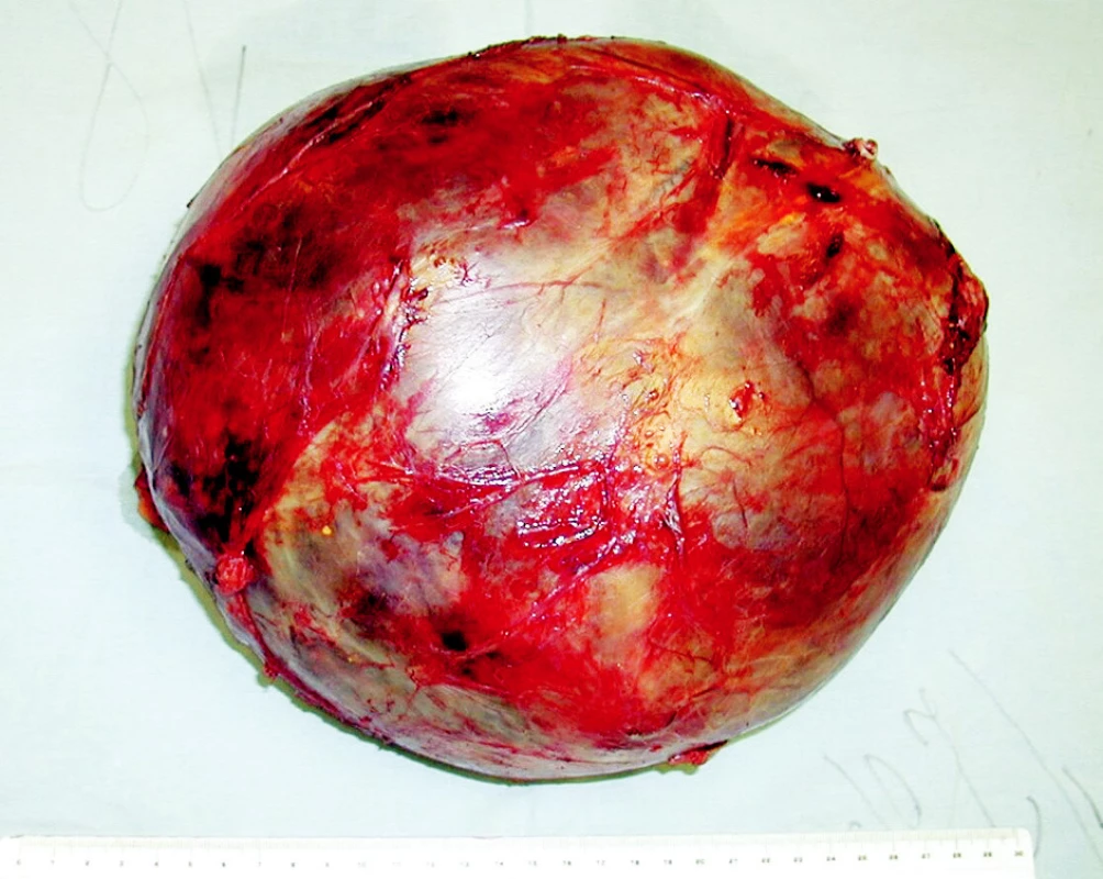 Tumor veľkosti 25x25x20 cm, ktorý bol kompletne exstirpovaný z pravého subfrenického priestoru.
Fig. 3. The tumor measuring 25x25x20 cm, which was completely removed from the right subphrenic region.