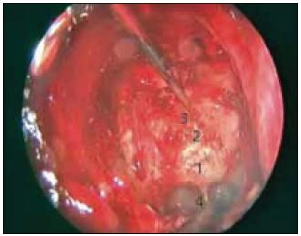 Otevření sfenoidální dutiny a zadních čichových sklípků pro transtuberkulární/transplanární přístup.
1 – spodina sedla, 2 – tuberculum sellae, 3 – planum sphenoidale, 4 – recesus clivalis