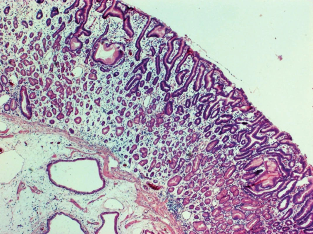 Tubular adenoma of the duodenum, HE, 40x