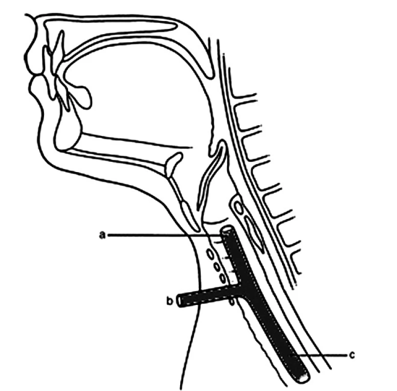 Montgomeryho T-kanyla