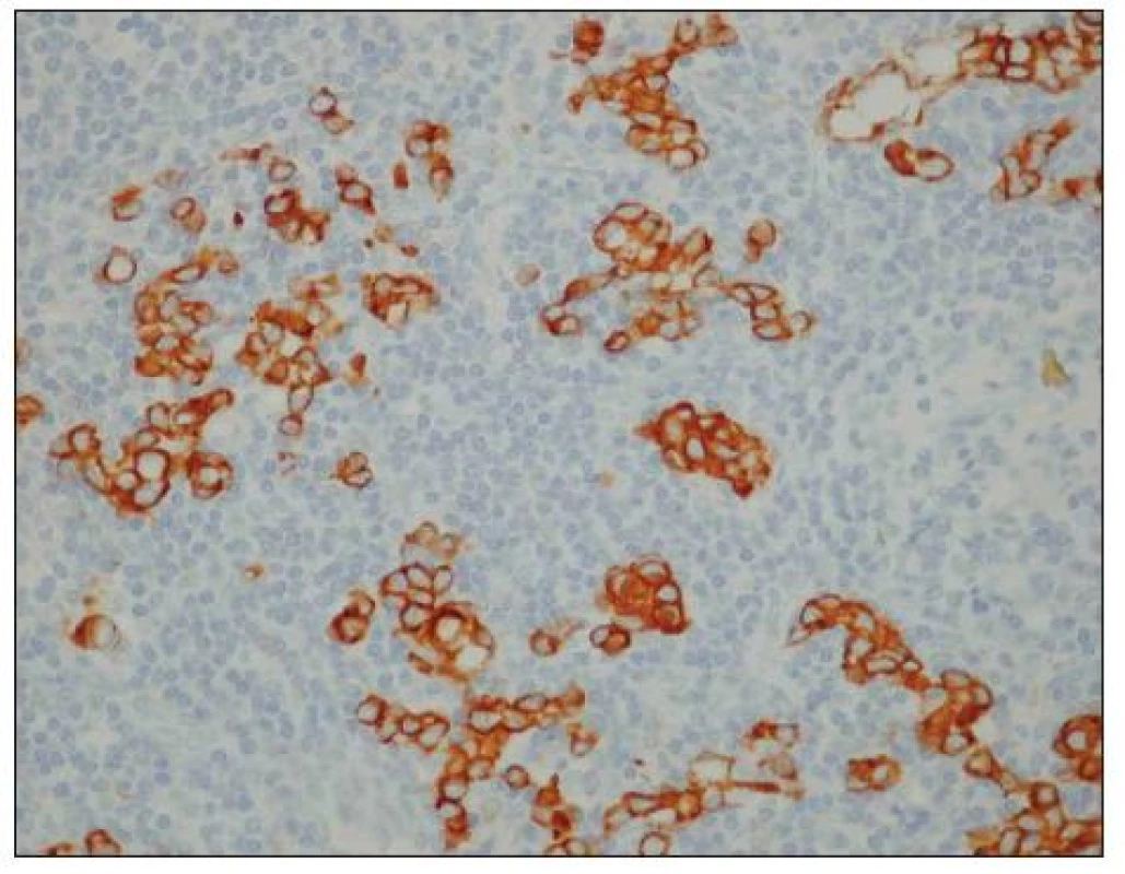 Uzlinové mikrometastázy karcinomu žaludku (hnědě zbarvené buňky). Optická mikroskopie, zvětšení 400x, immunohistochemické barvení (směs protilátek proti buněčným cytokeratinům AE1/AE3). S laskavým svolením prof. MUDr. R. Kodeta, CSc., přednosty Ústavu patologie a molekulární medicíny 2. LF UK a FN Motol.
Fig. 2. Gastric carcinoma lymph node micrometastases (brown stained cells). Optic microscopy, enlargement 400x, immunohistochemical staining (mixture of cytokeratin antibodies AE1/AE3). With kind approval by prof. MUDr. R. Kodet, CSc., Head of the Institute of Pathology and Molecular Medicine, 2nd Medical Faculty of the Charles University and Motol Faculty Hospital (LF UK and FN Motol).