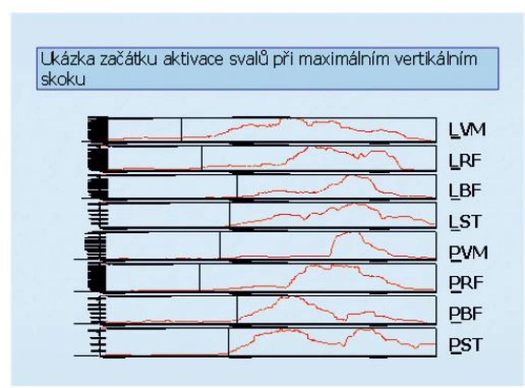 Ilustrativní ukázka aktivace vybraných svalů dolních končetin při maximálním vertikálním skoku. Vyšetřované svaly: L – svaly na levé dolní končetině, P − svaly na pravé dolní končetině, VM − m. vastus medialis, RF − m. rectus femoris, BF − m. biceps femoris, ST − m. semitendinosus. Začátek aktivace byl hodnocen softwarově pomocí programu MyoResearch XP Master Version 1.03.05. Začátek aktivity (dosažení 10% hodnoty maximálního peaku amplitudy během prováděného pohybu + hodnota klidové aktivity) je označen pro každý sval značkou.