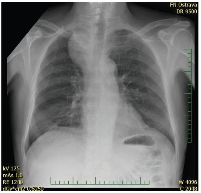 RTG snímek 3 týdny po operaci, výrazná regrese nálezu
Pic. 3. X-ray 3 weeks after surgery, significant regression