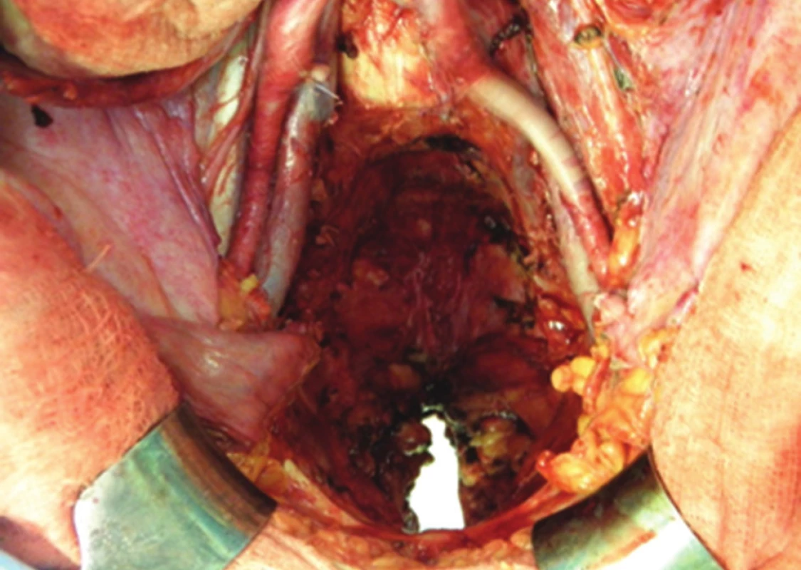 Operační nález: stav po totální pelvické exenteraci s rozsáhlým defektem hráze po vulvektomii
Fig. 5: Surgical finding: situation after total pelvic exenteration – extensive tissue loss of the perineum after vulvectomy