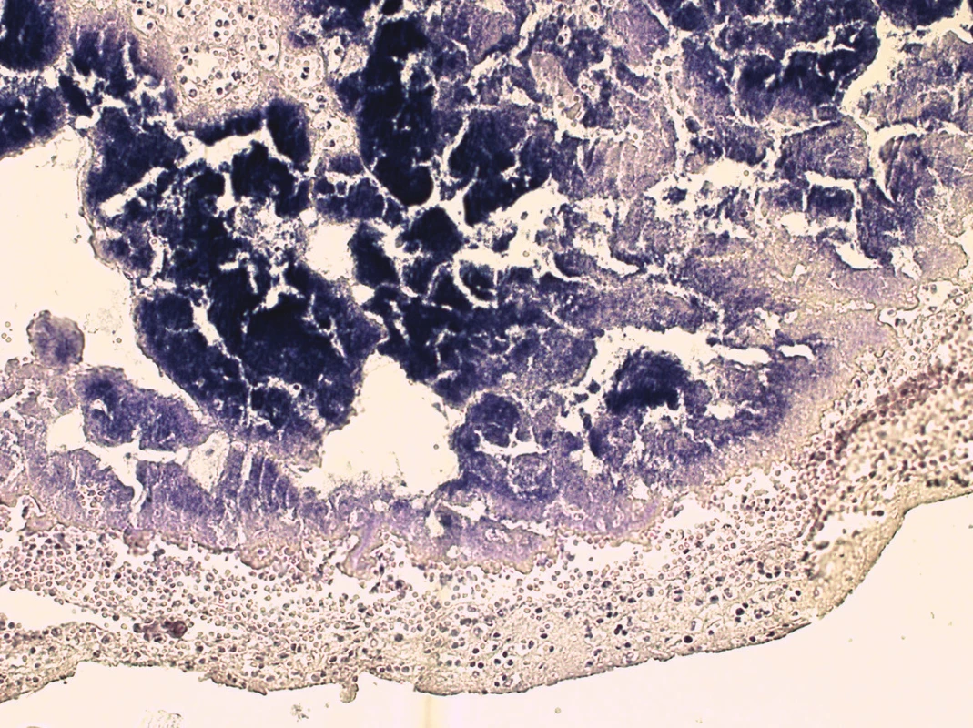 Histologický obraz pulmonální chlopně s koloniemi Gram-pozitivních koků a floridním zánětem (barvení podle Grama, 100x).